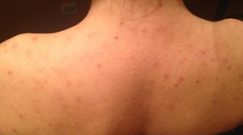 Почему появляется много прыщей на спине?