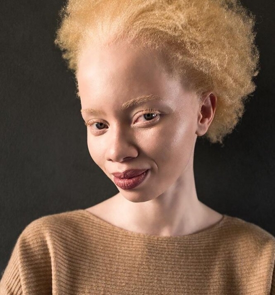 9 моделей с нестандартной внешностью, которые «взорвали» подиумы