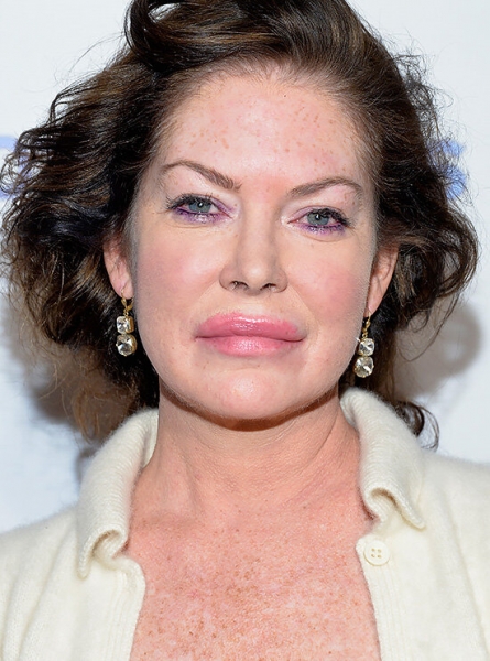 Памела Андерсон и&nbsp;другие звезды с&nbsp;узкими глазами после неудачной блефаропластики