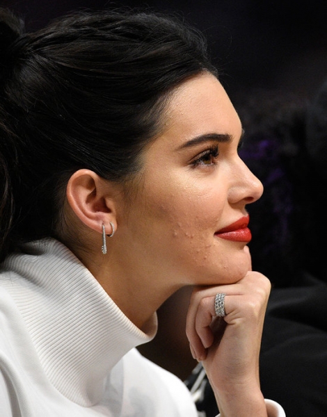 По стопам Кендалл Дженнер: причины и лечение акне во взрослом возрасте