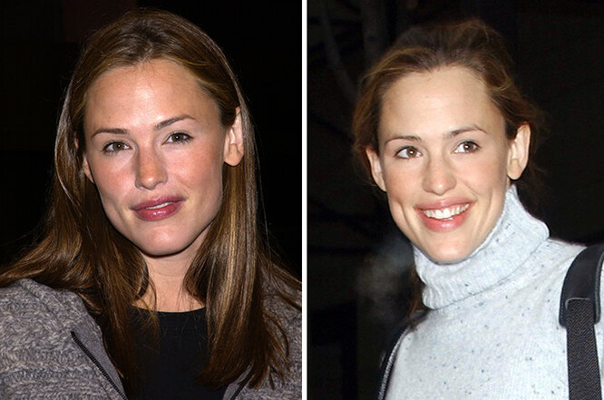 Пухлые губы без&nbsp;филлеров: что такое булхорн и&nbsp;кто из&nbsp;звезд уже сделал операцию