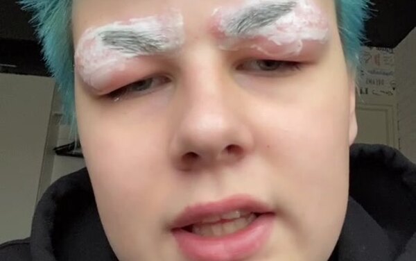 Загорелись волосы, выпали ресницы: домашние процедуры, которые пошли не&nbsp;по плану