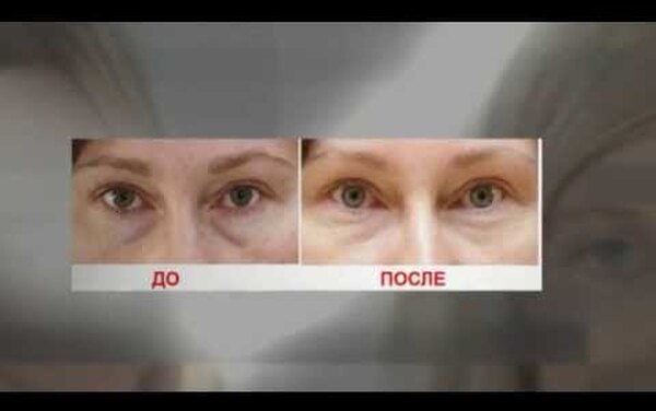 Что такое биоревитализация: всё, что нужно знать о процедуре