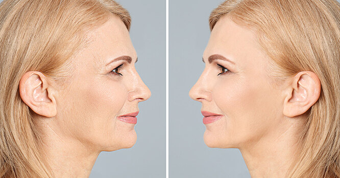 Что такое биоревитализация: всё, что нужно знать о процедуре