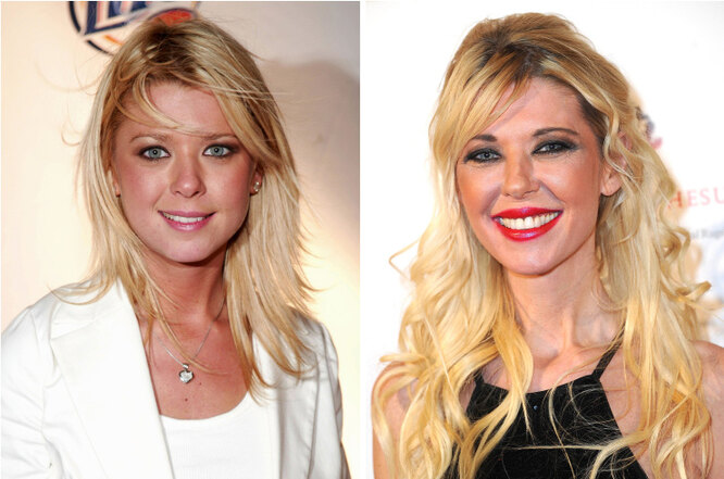 Наливные яблочки: звёзды, которые перестарались с&nbsp;увеличением впалых щёк