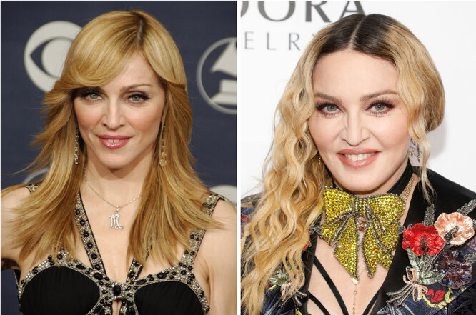 Наливные яблочки: звёзды, которые перестарались с&nbsp;увеличением впалых щёк