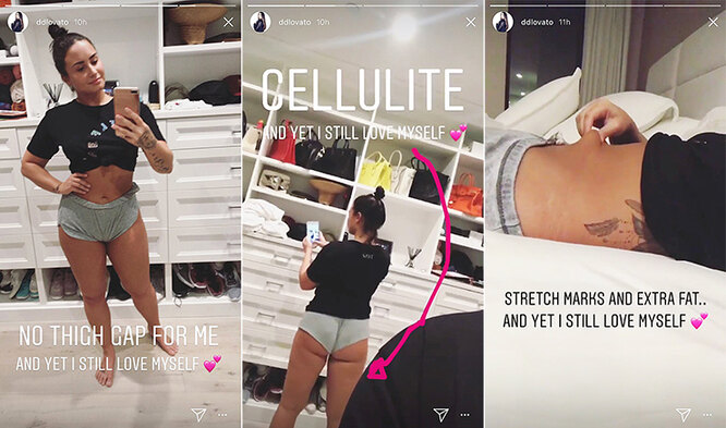 Рианна, Гомес и другие звезды, которые не скрывают следы растяжек на теле