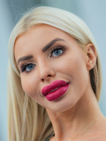 Рот на пол-лица: звезды, которые переборщили с инъекциями в губы