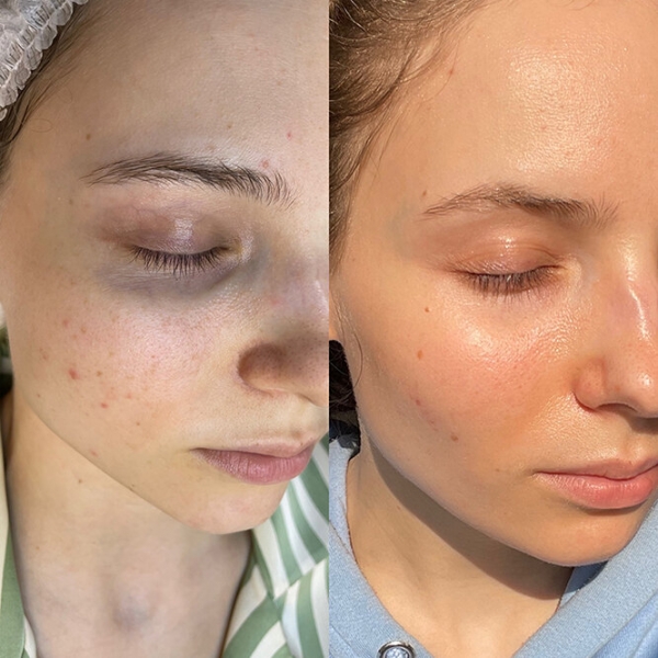 Свет лечит! Что такое BBL и как он убирает пигментацию и акне — фото до и после