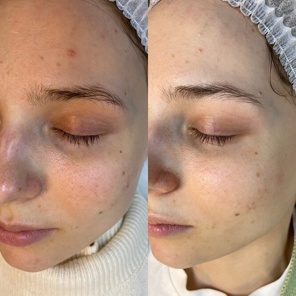 Свет лечит! Что такое BBL и как он убирает пигментацию и акне — фото до и после