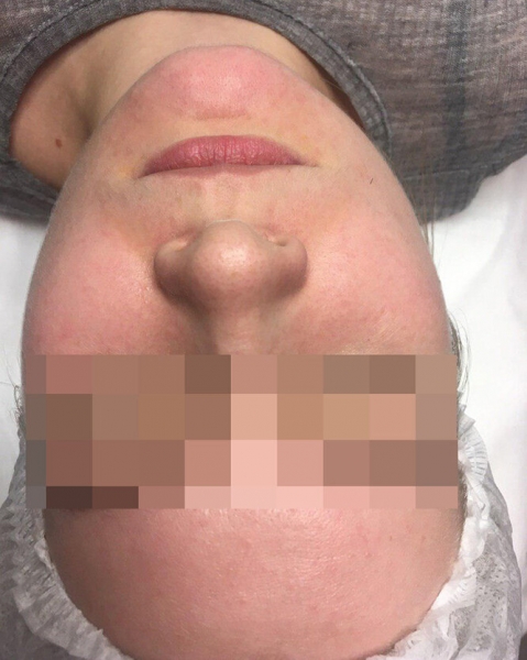 Свет лечит! Что такое BBL и как он убирает пигментацию и акне — фото до и после