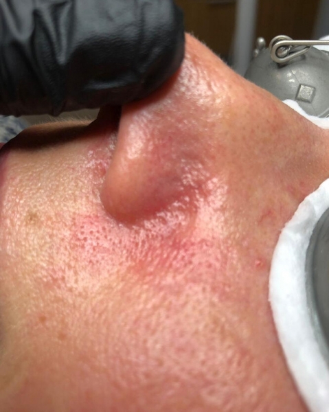 Свет лечит! Что такое BBL и как он убирает пигментацию и акне — фото до и после