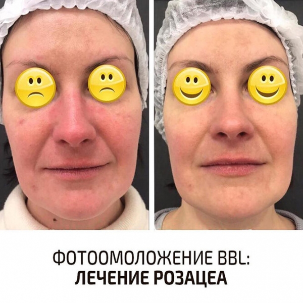 Фотоомоложение лица:  ответы на&nbsp;все вопросы, результаты и&nbsp;личный опыт редактора