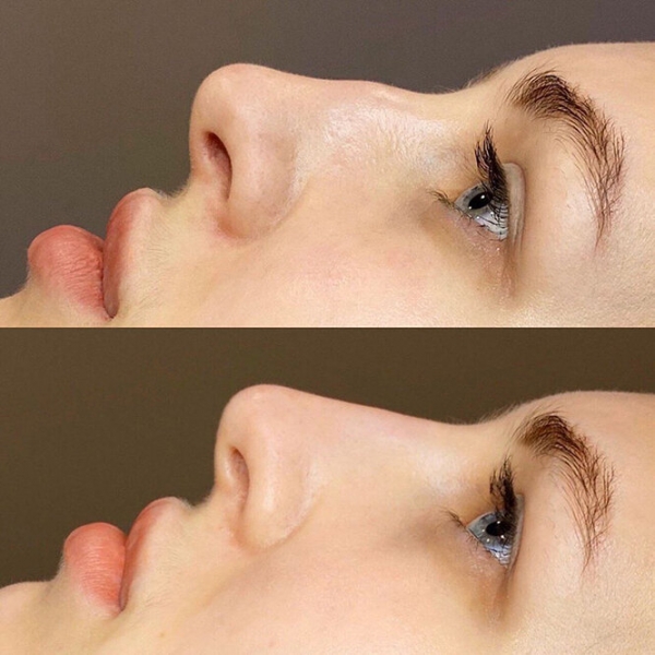 Фотоомоложение лица:  ответы на&nbsp;все вопросы, результаты и&nbsp;личный опыт редактора