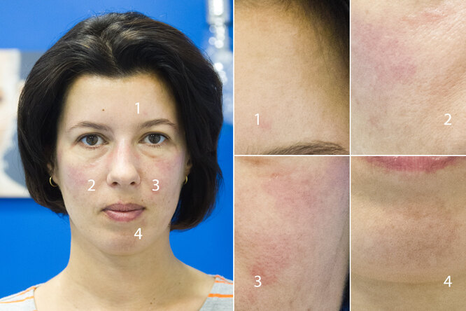 Фотоомоложение лица:  ответы на&nbsp;все вопросы, результаты и&nbsp;личный опыт редактора