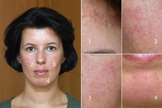 Фотоомоложение лица:  ответы на&nbsp;все вопросы, результаты и&nbsp;личный опыт редактора