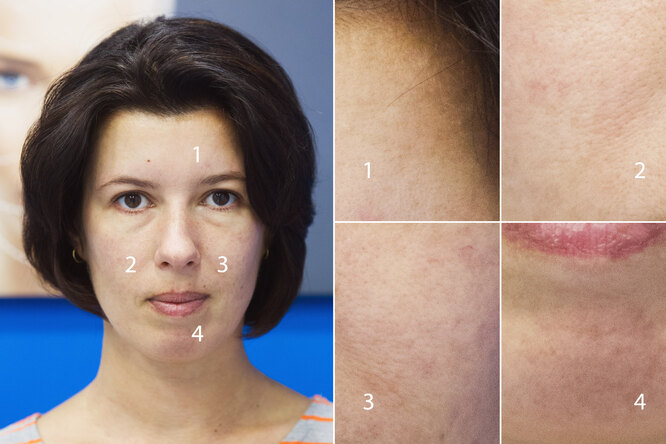 Фотоомоложение лица:  ответы на&nbsp;все вопросы, результаты и&nbsp;личный опыт редактора