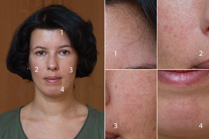 Фотоомоложение лица:  ответы на&nbsp;все вопросы, результаты и&nbsp;личный опыт редактора