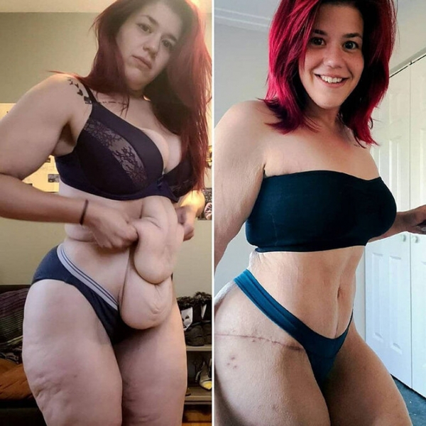 Лучше не стало! Как выглядят тела женщин, похудевших на 50, 100 и даже 150 кг