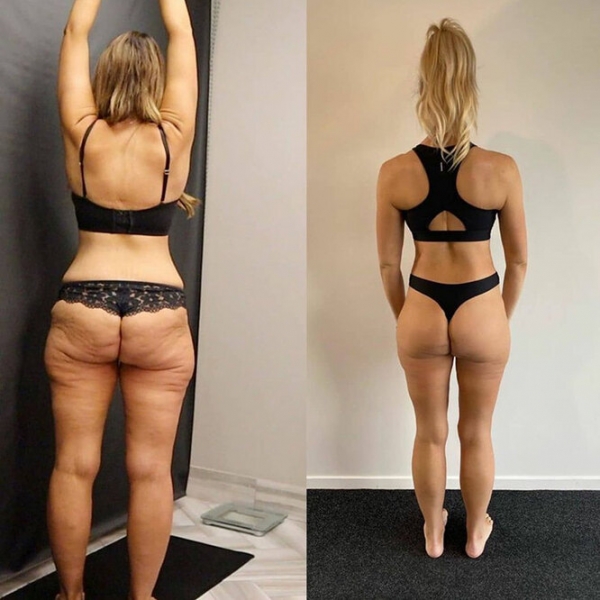 Лучше не стало! Как выглядят тела женщин, похудевших на 50, 100 и даже 150 кг