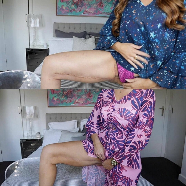 Лучше не стало! Как выглядят тела женщин, похудевших на 50, 100 и даже 150 кг