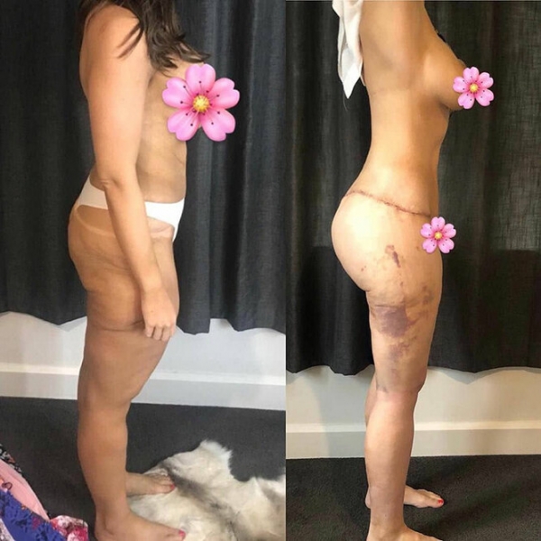 Лучше не стало! Как выглядят тела женщин, похудевших на 50, 100 и даже 150 кг