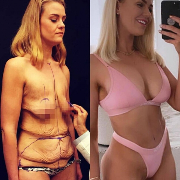 Лучше не стало! Как выглядят тела женщин, похудевших на 50, 100 и даже 150 кг