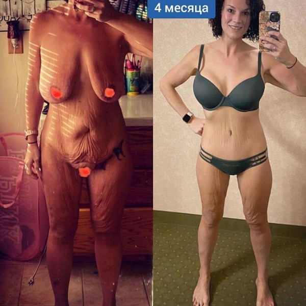 Лучше не стало! Как выглядят тела женщин, похудевших на 50, 100 и даже 150 кг