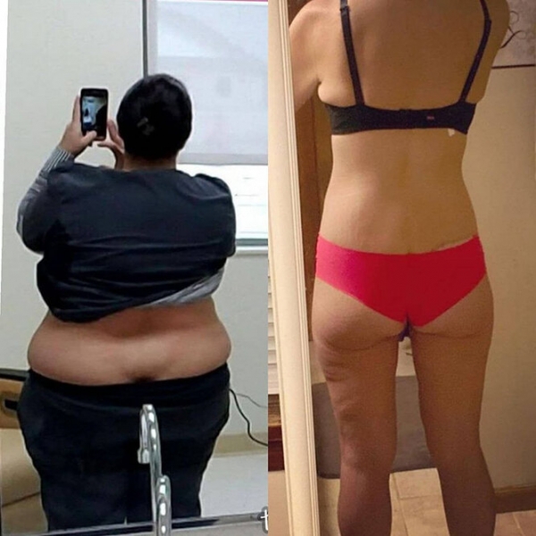 Лучше не стало! Как выглядят тела женщин, похудевших на 50, 100 и даже 150 кг