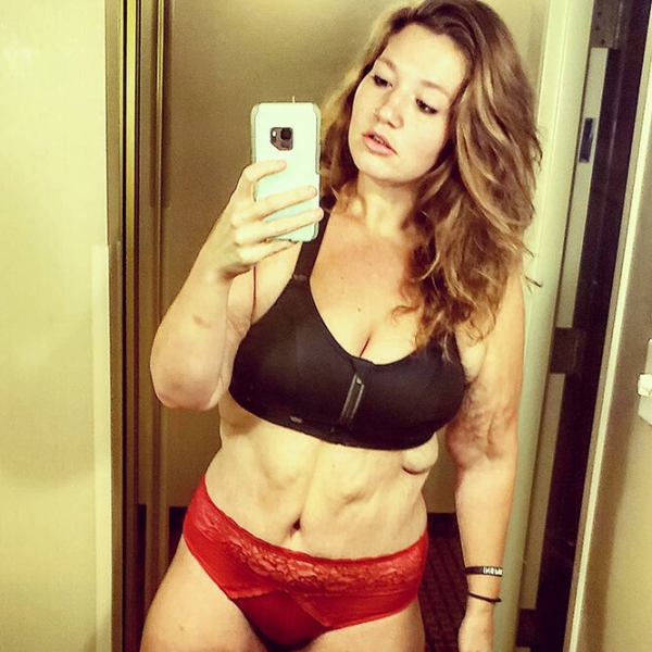 Лучше не стало! Как выглядят тела женщин, похудевших на 50, 100 и даже 150 кг