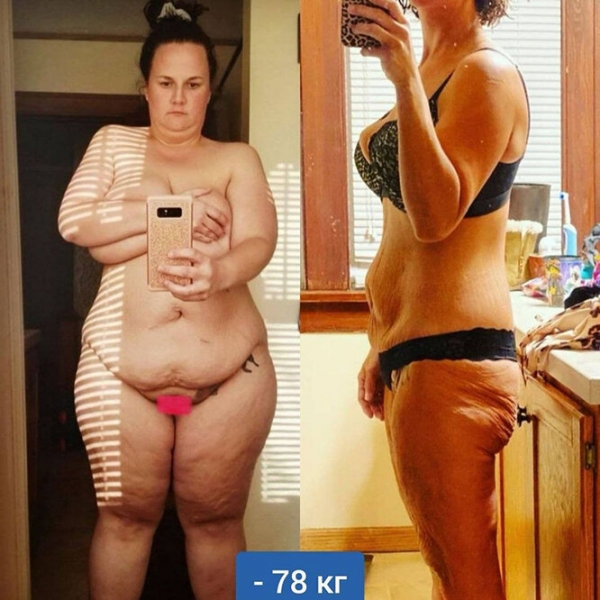 Лучше не стало! Как выглядят тела женщин, похудевших на 50, 100 и даже 150 кг