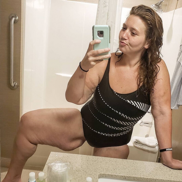 Лучше не стало! Как выглядят тела женщин, похудевших на 50, 100 и даже 150 кг