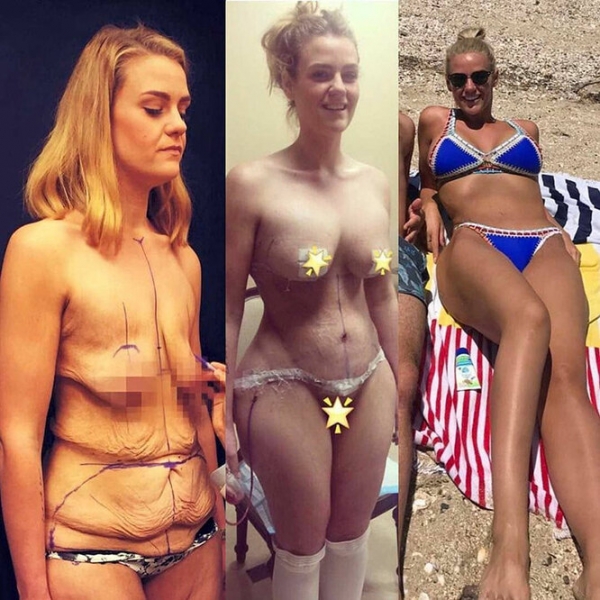 Лучше не стало! Как выглядят тела женщин, похудевших на 50, 100 и даже 150 кг