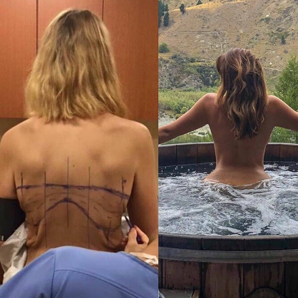 Лучше не стало! Как выглядят тела женщин, похудевших на 50, 100 и даже 150 кг