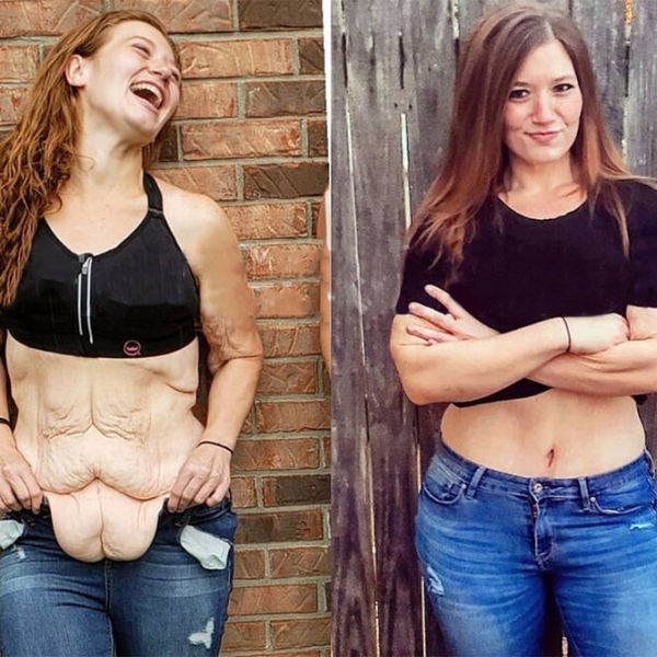 Лучше не стало! Как выглядят тела женщин, похудевших на 50, 100 и даже 150 кг