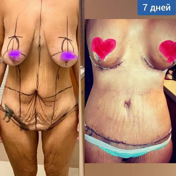 Лучше не стало! Как выглядят тела женщин, похудевших на 50, 100 и даже 150 кг