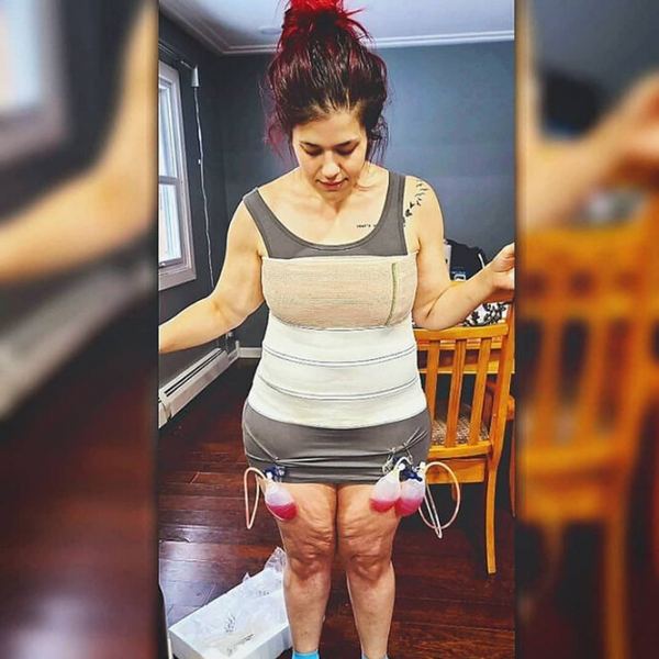 Лучше не стало! Как выглядят тела женщин, похудевших на 50, 100 и даже 150 кг