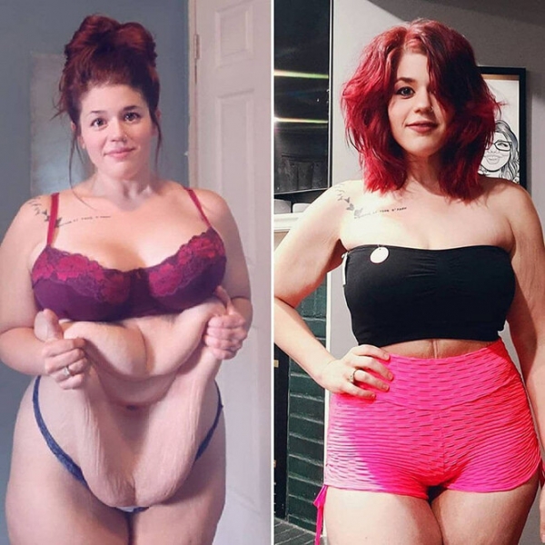 Лучше не стало! Как выглядят тела женщин, похудевших на 50, 100 и даже 150 кг