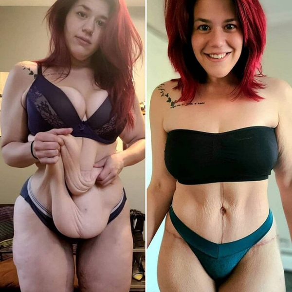 Лучше не стало! Как выглядят тела женщин, похудевших на 50, 100 и даже 150 кг