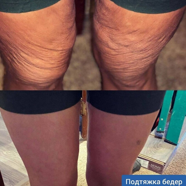 Лучше не стало! Как выглядят тела женщин, похудевших на 50, 100 и даже 150 кг