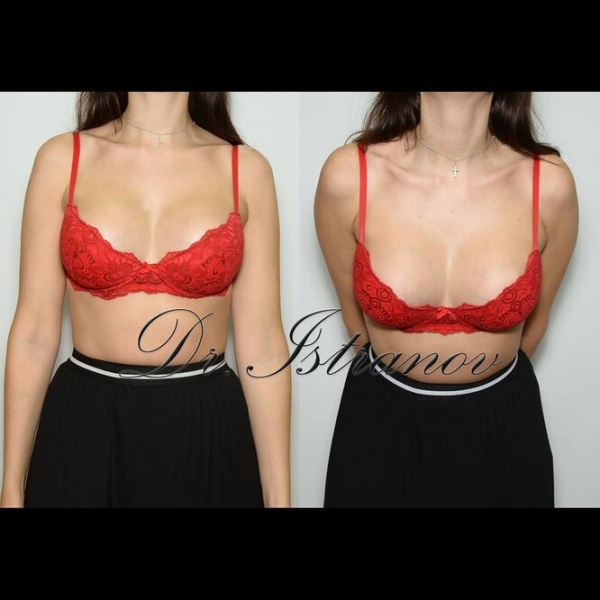 «Сделала грудь» и не пожалела: реальная история маммопластики