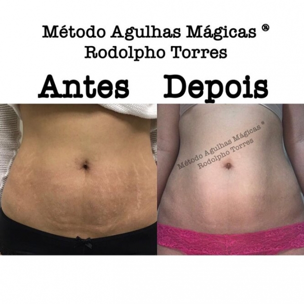 Странная мода: «трещина» на прессе, пирсинг пальца и другие модификации тела