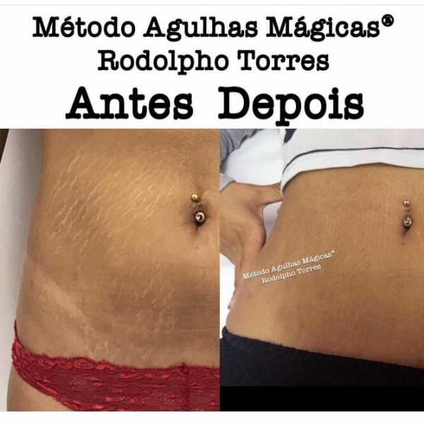 Странная мода: «трещина» на прессе, пирсинг пальца и другие модификации тела