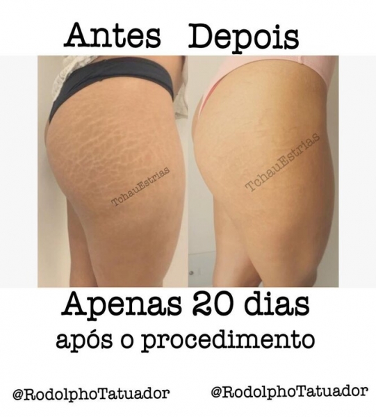 Странная мода: «трещина» на прессе, пирсинг пальца и другие модификации тела