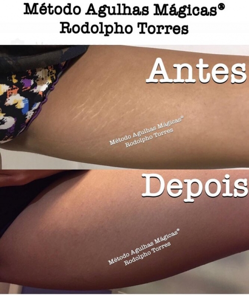 Странная мода: «трещина» на прессе, пирсинг пальца и другие модификации тела