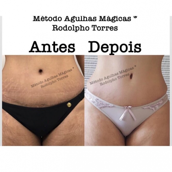 Странная мода: «трещина» на прессе, пирсинг пальца и другие модификации тела