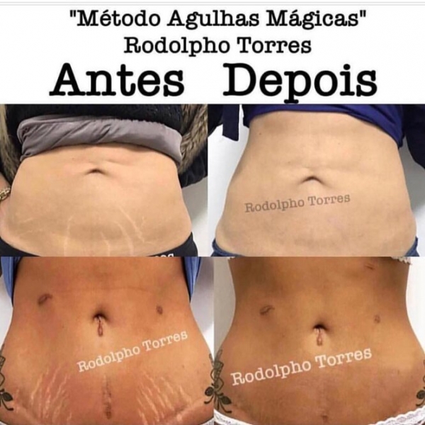 Странная мода: «трещина» на прессе, пирсинг пальца и другие модификации тела