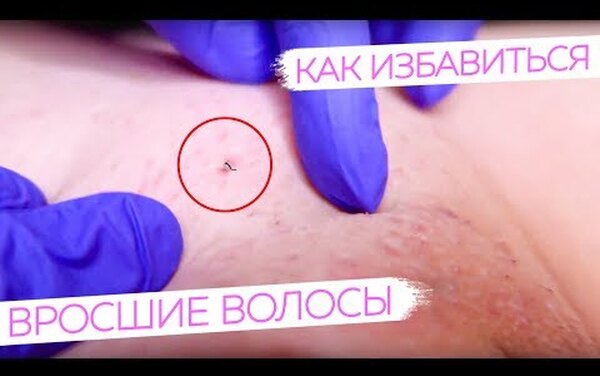 Всё будет гладко: как избавиться от&nbsp;вросших волос после эпиляции