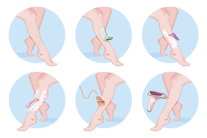 Всё будет гладко: как избавиться от&nbsp;вросших волос после эпиляции