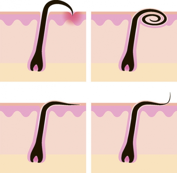 Всё будет гладко: как избавиться от&nbsp;вросших волос после эпиляции